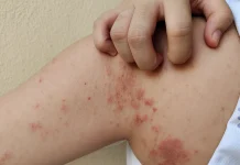 Confirmaron dos casos de lepra en Salta